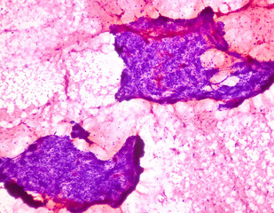 Photomicrograph of Osteolytic lesion of left proximal radium, Positive for malignant cell, small...