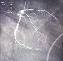 Coronary angiogram of left coronary artery during cardiac catheterization with contrast dye. Abnormal findings. Colour adjust.