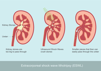 Extracorporeal shock wave lithotripsy (ESWL).