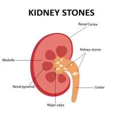 Kidney stones disease vector illustration
