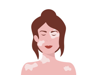 Portrait of a happy young woman with vitiligo. Close up of woman with skin disorder. Female character with vitiligo. Vector illustration on isolated background.