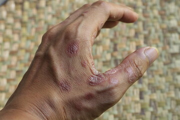 inflamed, peeling and damaged hand skin due to R-CHOPP chemotherapy treatment