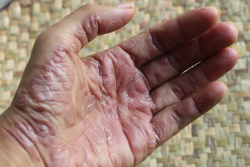 inflamed, peeling and damaged hand skin due to R-CHOPP chemotherapy treatment