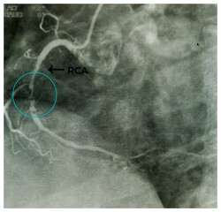 Coronary angiogram of right coronary artery during cardiac catheterization with dye. Findings...