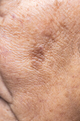 Naklejka premium Woman's problematic skin pore and dark spots on the face