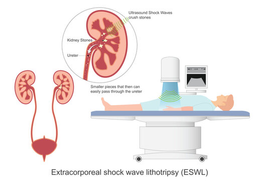 Extracorporeal shock wave lithotripsy ESWL.