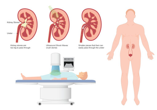 Extracorporeal Shock Wave Lithotripsy (ESWL) is the use.