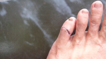 Torn wound that has begun to heal on the little toe. laceration on finger