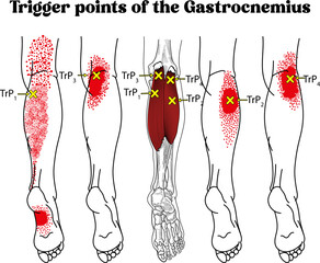 Trigger points  diagram, Trigger points of the Gastrocnemius
