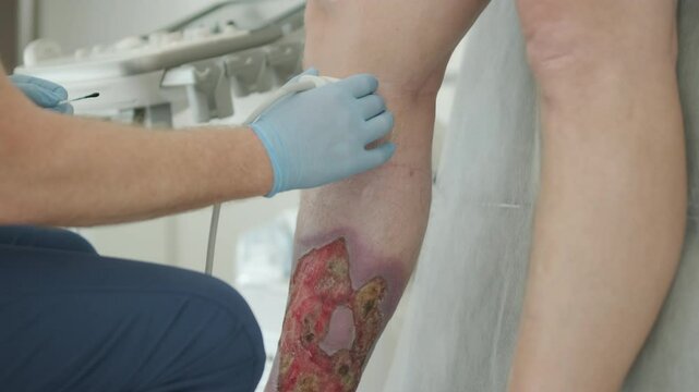 Medical Ultrasound Exam on Patient with Leg Ulcer