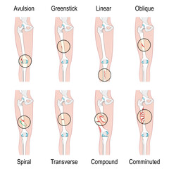Types of bone fracture.