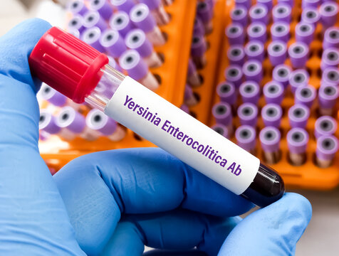 Blood sample for Yersinia antigen test or Yersiniosis.Yersiniosis Culture Test.