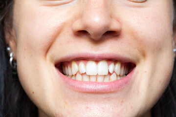 Close-up of a smiling woman showing slightly crooked teeth