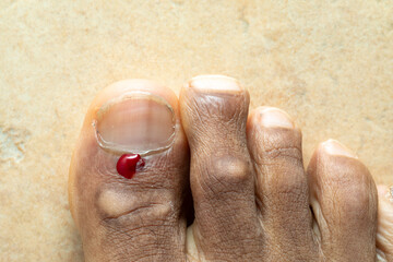 Bleeding toe injury: close-up of blood drop on injured foot