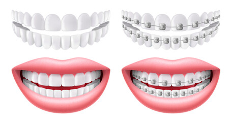 Teeth with or without braces. Arch braces without teeth. Orthodontic dentistry. The alignment of the teeth. Smile with white teeth and braces. Isolated realistic 3d vector