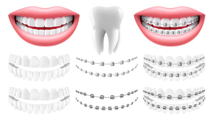 Teeth with or without braces. Arch braces without teeth. Orthodontic dentistry. The alignment of the teeth. Smile with white teeth and braces. Isolated realistic 3d vector