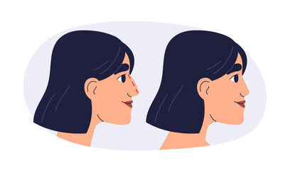 Fototapeta premium Rhinoplasty, plastic surgery before and after. Woman patient profile, nose reshaping and cosmetic aesthetic enhancement, modification, correction. Flat vector illustration isolated on white background