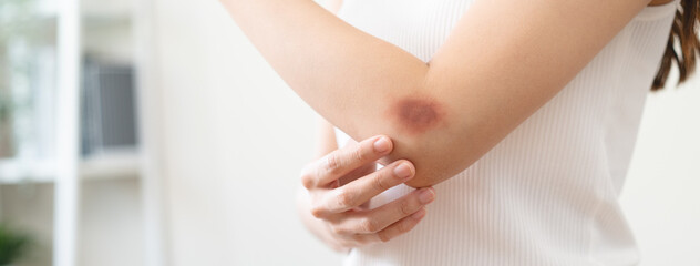 Close-up purple bruised on the arm of human from accident.