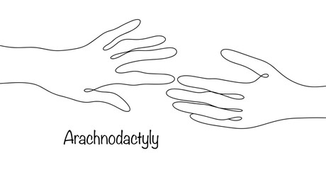 Arachnodactyly