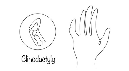 Clinodactyly