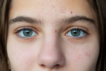 Fototapeta premium Close-up of teenage girl with acne on forehead and nose. A close-up portrait of a teenage girl with light blue eyes and a natural skin complexion, showing acne on her forehead and nose.