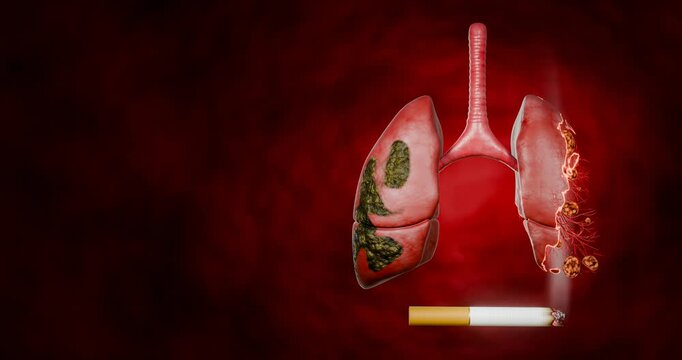 Lung cancer. Noncommunicable diseases or NCDs. Lung infections spread due to inhalation of cigarette smoke or dust. 3D Rendering.