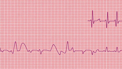 Long QT syndrome ECG, 2nd type, 3D illustration isolated with white shades, png