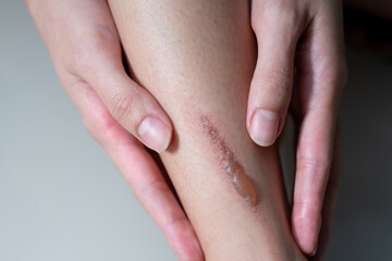 Woman leg blistered and red skin from accidental scalds.