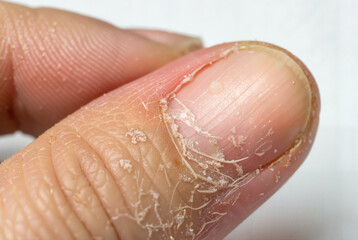 Fototapeta premium Close-up of peeling skin around fingernail