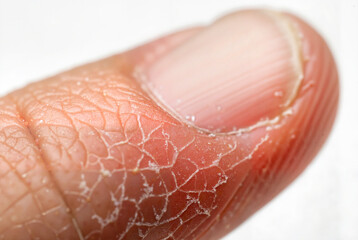 Fototapeta premium Close-up of dry, cracked skin on thumb