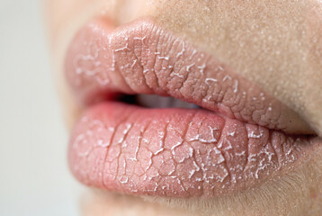Fototapeta premium Close-up of chapped, dry lips with peeling skin
