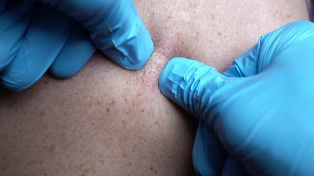 Cosmetologist removes large comedones on the patient's skin, blackhead removal procedure, close-up video