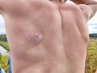An ulcer on a man's back with surrounding skin irritation during an outdoor gathering near a river