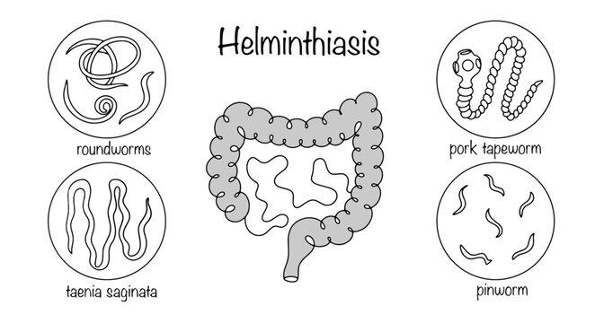 Helminthiasis of the intestines