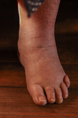 old seniors with swollen feet ,elderly people.edema or swelling in the feet.kidney or liver disease,Dry skin.Feet of a senior woman between 70 and 80 years old.Close-up .health problems concept