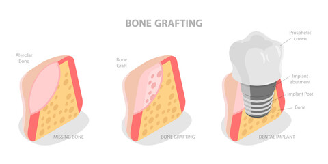 3D Isometric Flat  Illustration of Bone Grafting, Understanding of Teeth Structure for Successful Treatment