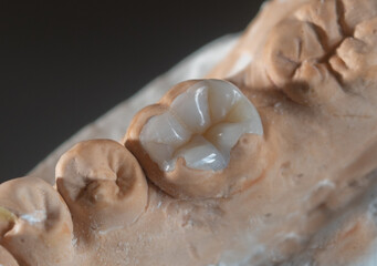 Dental Restoration with Ceromer: Quality and Natural Aesthetics,onlay
