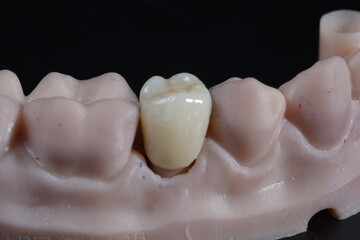 zirconia denture processing with dental digital cam/cad 