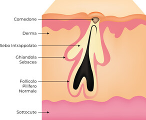 Comedone Derma Sottocute Science Design Vector Illustration Diagram