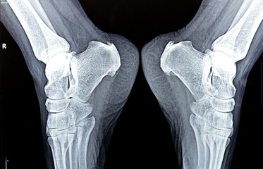 Plain X ray of female patient foot shows calcaneal heel spur, bony outgrowth forms on the heel bone, Plantar fasciitis, an inflammation of the fibrous tissue and calcified Achilles tendon