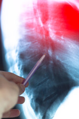 Pneumonia, inflammatory condition of the lung. Doctor examining fluorography, x-ray scan. Medical treatment concept. Diagnosis of the disease humans lungs.