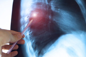 Pneumonia, inflammatory condition of the lung. Doctor examining fluorography, x-ray scan. Medical treatment concept. Diagnosis of the disease humans lungs.