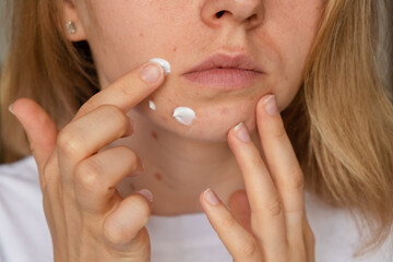 Unrecognizable woman applies makeup, cream serum cure for acne on face. Close-up acne on woman's...
