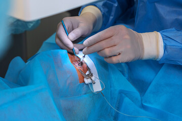 Surgeon Conducting Delicate Eye Surgery with Precision Tools