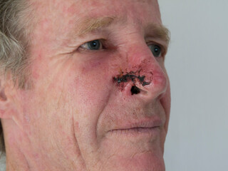Mans nose with wound from plastic surgery BCC removal