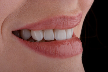 Female smile makeover by dental ceramic veneer, porcelain laminate veneers. Side view