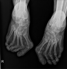 Bilateral foot Rheumatoid arthritis  X-Ray Imaging