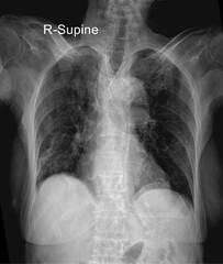 Chest X-Ray Supine for Diagnostic Use