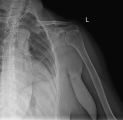 High-Resolution X-Ray of the Shoulder Joint for Glenohumeral Analysis