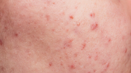 Fototapeta premium Many pimples. Bad skin. Hormonal acne, puberty. Skin acne background. Closeup acne pimple. Treatment for acne skin. Problem skincare. Pimples, pores, scars. Skincare treatment.